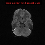 File:Neurofibromatosis type 1 with optic nerve glioma (Radiopaedia 16288-15965 Axial DWI 39).jpg