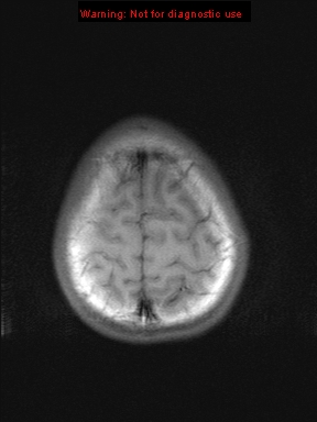 File:Neurofibromatosis type 1 with optic nerve glioma (Radiopaedia 16288-15965 Axial T1 3).jpg