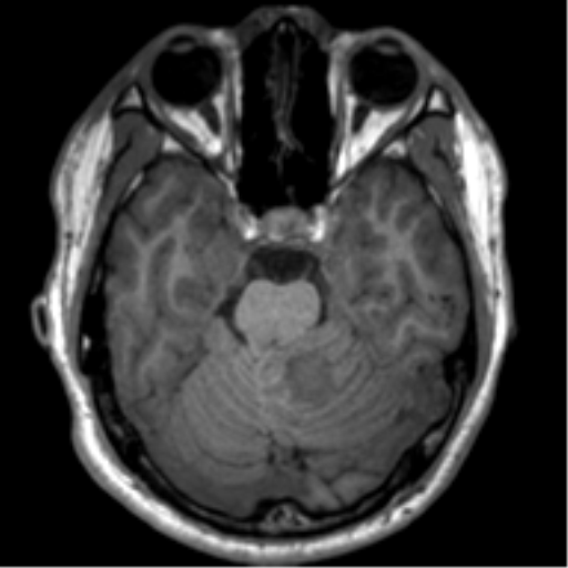 File:Neurofibromatosis type 2 (Radiopaedia 44936-48838 Axial T1 41).png