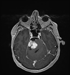 Neurofibromatosis type 2 (Radiopaedia 79097-92049 Axial T1 C+ 70).jpg