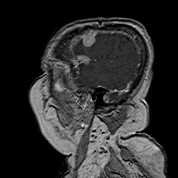 File:Neurofibromatosis type 2 (Radiopaedia 8713-9518 Sagittal T1 C+ 8).jpg