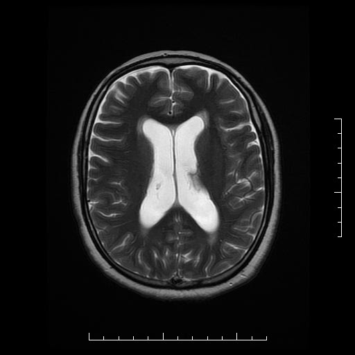 File:Neuroglial cyst of brainstem (Radiopaedia 29134-29526 Axial T2 13).jpg