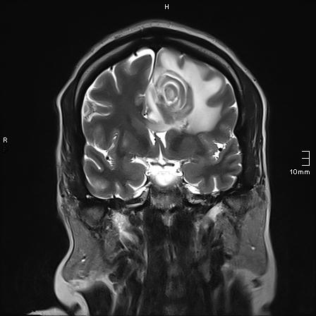 File:Neurotoxoplasmosis - concentric target sign (Radiopaedia 70644-80784 Coronal T2 27).jpg