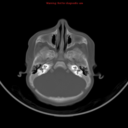 File:Non-accidental injury - bilateral subdural with acute blood (Radiopaedia 10236-10765 Axial bone window 5).jpg