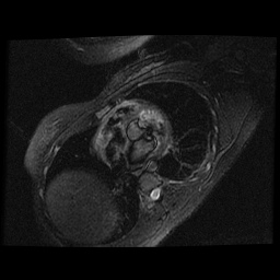 File:Non-compaction of the left ventricle (Radiopaedia 38868-41062 D 14).jpg