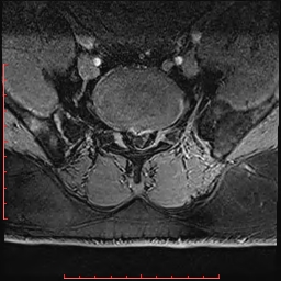 Non Hodgkin's lymphoma with metastasis to spine (Radiopaedia 54844-61103 Axial T1 C+ fat sat 16).jpg