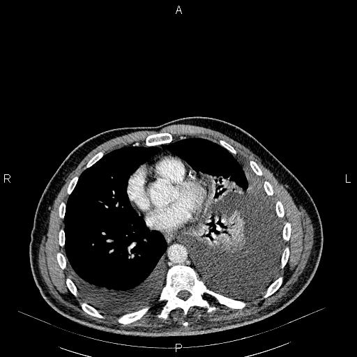 File:Non Hodgkin lymphoma in a patient with ankylosing spondylitis (Radiopaedia 84323-99621 B 21).jpg