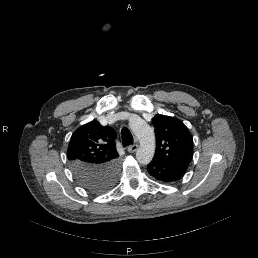 File:Non Hodgkin lymphoma in a patient with ankylosing spondylitis (Radiopaedia 84323-99624 B 9).jpg