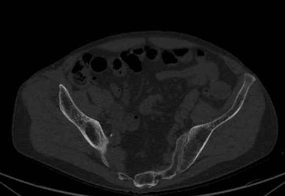 File:Nondisplaced incomplete intertrochanteric fracture (Radiopaedia 73736-84539 Axial bone window 1).jpg