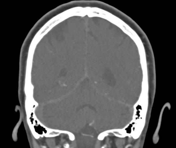 File:Normal CTA head (Radiopaedia 40801-43464 B 70).png
