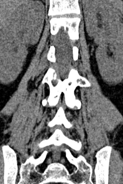 Normal CT lumbar spine (Radiopaedia 53981-60118 F 62).jpg
