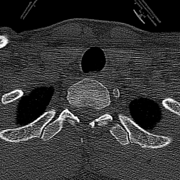 File:Normal CT of the cervical spine (Radiopaedia 53322-59305 Axial bone window 246).jpg