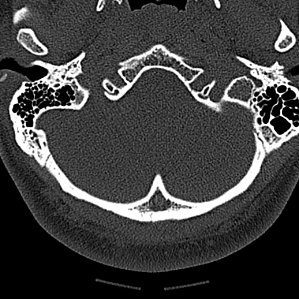 Normal CT of the cervical spine (Radiopaedia 53322-59305 Axial bone window 27).jpg