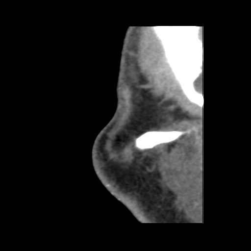 Normal CT paranasal sinuses (Radiopaedia 42286-45390 F 15).jpg
