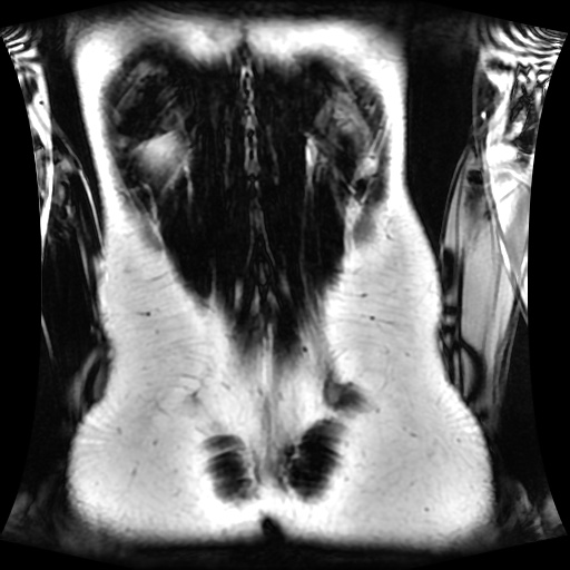 Normal MRI abdomen in pregnancy (Radiopaedia 88001-104541 N 121).jpg