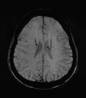 Normal MRI internal auditory canal (Radiopaedia 41613-44525 Axial SWI MIP 54).png