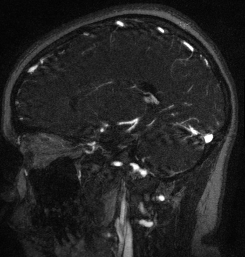 Normal brain MRI and venogram (Radiopaedia 39554-41862 Sagittal MRV 24).jpg