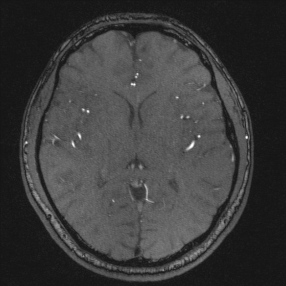 Normal brain MRI including MRA (Radiopaedia 48748-53763 Axial MRA 117).jpg