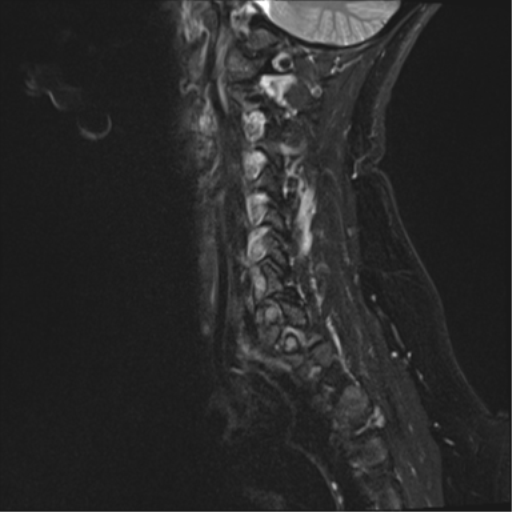 File:Normal cervical spine MRI (including Dixon) (Radiopaedia 42762-45925 Dixon- Water 2).png