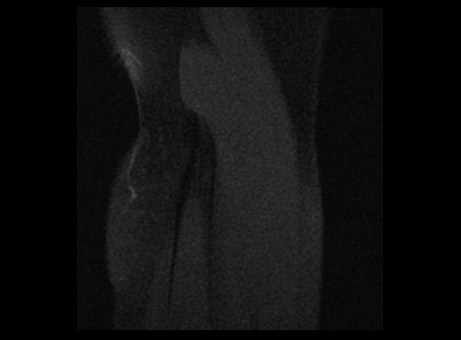 File:Normal elbow arthrograms (Radiopaedia 75550-86805 Sagittal T1 fat sat 3).jpg