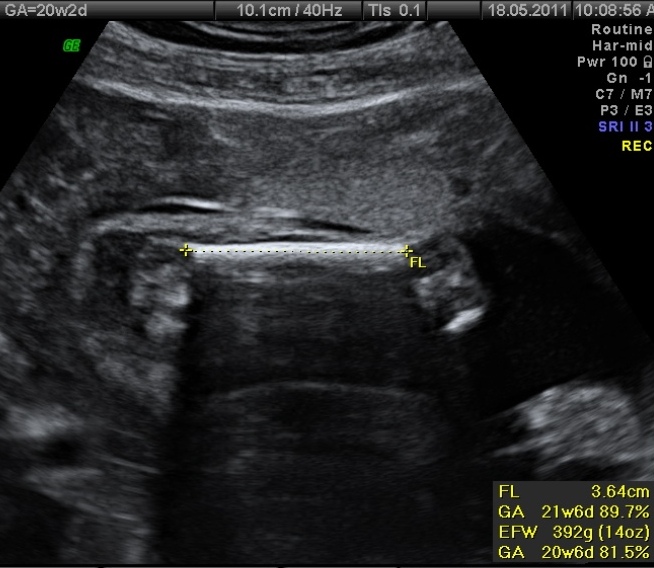 File:Normal fetal biometry - second trimester (Radiopaedia 26450-26580 femur length 1).jpg