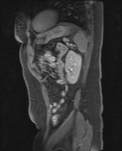 File:Normal hepatobiliary phase liver MRI (Radiopaedia 58968-66230 C 61).jpg