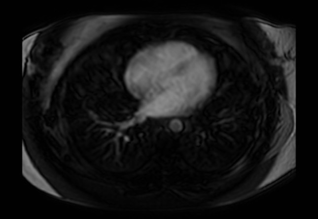 Normal liver MRI with Gadolinium (Radiopaedia 58913-66163 J 85).jpg
