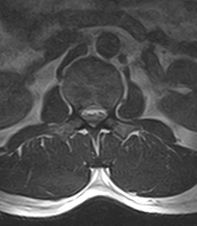 Normal lumbar spine MRI - low-field MRI scanner (Radiopaedia 40976-43699 Axial T2 26).jpg