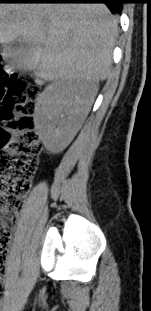 Normal lumbosacral CT (Radiopaedia 37923-39867 E 96).png