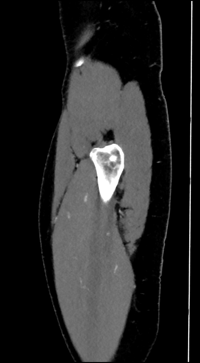 Normal pelvis CT angiogram (Radiopaedia 84966-100481 C 8).jpg