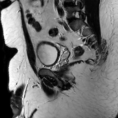 File:Normal prostate (MRI) (Radiopaedia 29986-30535 Sagittal T2 6).jpg