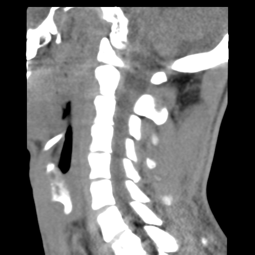 File:Normal trauma cervical spine (Radiopaedia 41017-43760 B 18).png