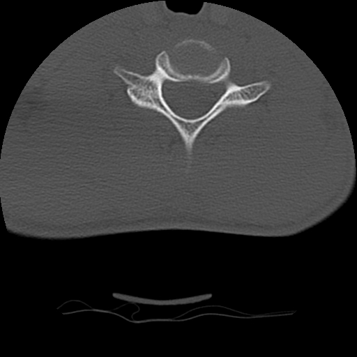 File:Normal trauma spine imaging (age 16) (Radiopaedia 45335-49358 Axial bone window 60).jpg