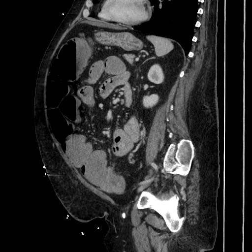 Obstructive colonic diverticular stricture (Radiopaedia 81085-94675 C 149).jpg