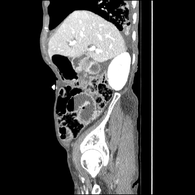 Obturator hernia causing small bowel obstruction (Radiopaedia 65522-74612 C 75).jpg