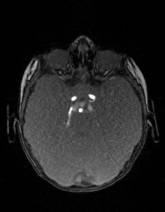 Occipital horn syndrome (Radiopaedia 14255-14129 MRA 54).jpg