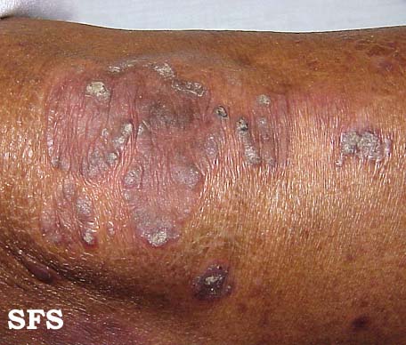 File:Psoriasis (Dermatology Atlas 7).jpg