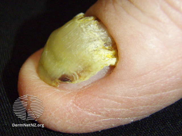File:Yellow nail syndrome (DermNet NZ 090-yellow-nail).jpg