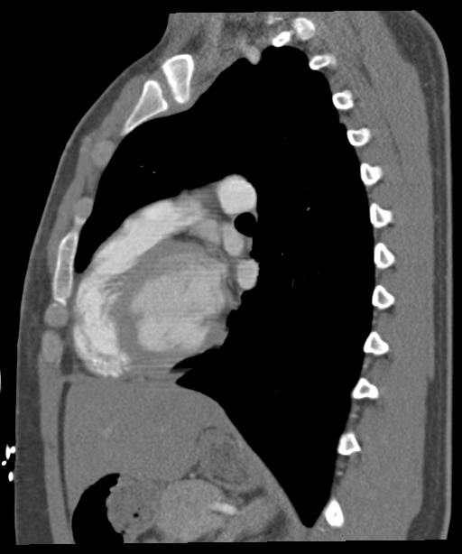 'Bovine' aortic arch (Radiopaedia 33554-34637 B 28).png