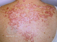 File:(DermNet NZ immune-subacute-lupus-01-s).jpg