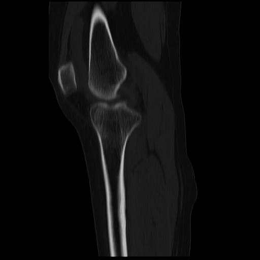 File:ACL avulsion fracture (Radiopaedia 33833-34994 Sagittal bone window 28).jpg