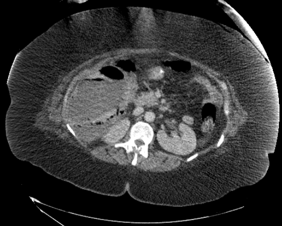 File:Abdominal abscess - pre and post percutaneous drainage (Radiopaedia 60209-67816 Axial 31).png