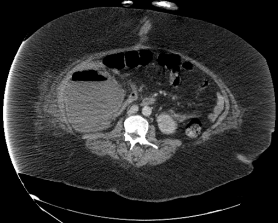 File:Abdominal abscess - pre and post percutaneous drainage (Radiopaedia 60209-67816 Axial 4).png