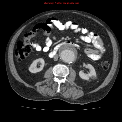 Abdominal aortic aneurysm (Radiopaedia 10122-10660 Axial C+ portal venous phase 37).jpg