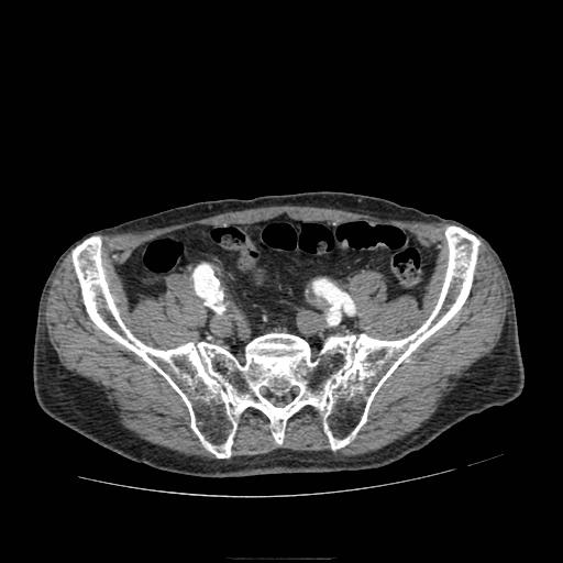 Abdominal aortic aneurysm (Radiopaedia 13341-13340 Axial C+ arterial phase 187).jpg
