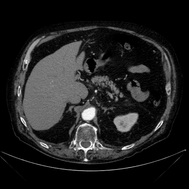 Abdominal aortic aneurysm (Radiopaedia 25855-26001 Axial C+ arterial phase 39).jpg
