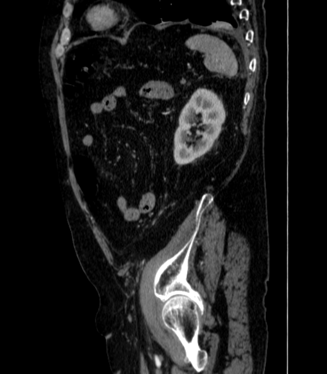 Abdominal aortic aneurysm (Radiopaedia 25855-26001 Sagittal C+ arterial phase 67).jpg