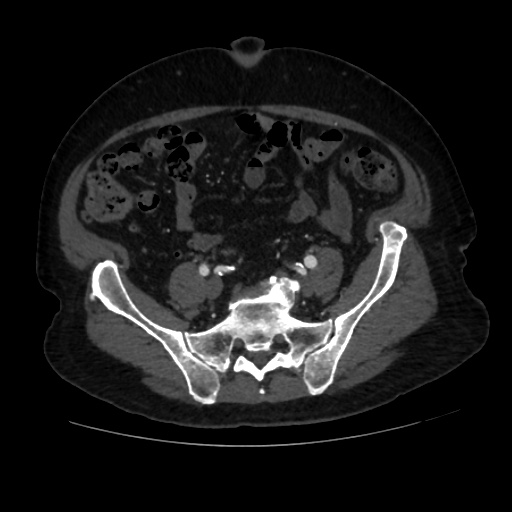 File:Abdominal aortic aneurysm (Radiopaedia 57318-64259 Axial C+ arterial phase 54).jpg