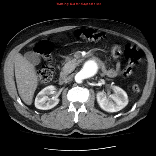 Abdominal aortic aneurysm (Radiopaedia 8190-9038 Axial C+ arterial phase 32).jpg
