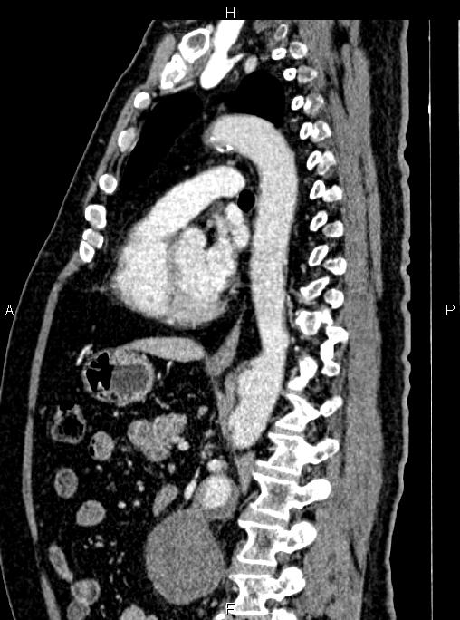 Abdominal aortic aneurysm (Radiopaedia 83094-97462 Sagittal renal cortical phase 72).jpg